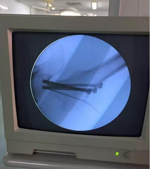 深圳雪象医院运用微创手术又治愈一例股骨转子间骨折