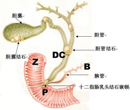 胆结石患者需要做哪些检查