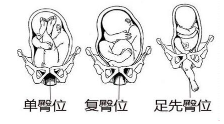 胎位不正能矫正过来吗