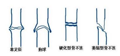 骨不连