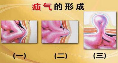疝气