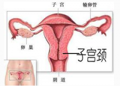 治疗宫颈炎要多少费用