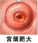 治疗宫颈肥大要多少钱