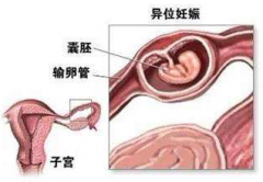 治疗宫外孕要多少钱