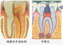 治疗牙髓炎哪些方法好