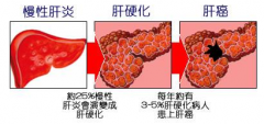 进行肝脏自检有哪些方法