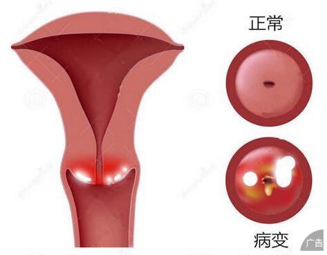 什么方式可以诊断宫颈白斑