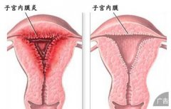 子宫内膜炎早期症状