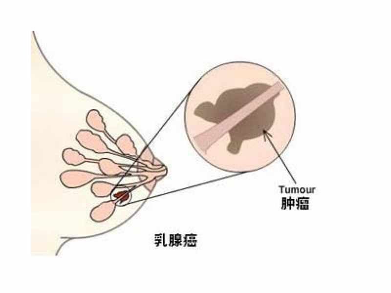 乳腺癌治疗需要多少钱