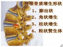 骨质增生有哪些检查项目